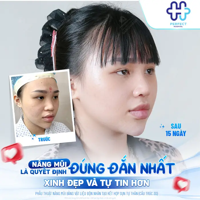 Nâng Mũi Bao Lâu Thì Ổn Định? Thời Gian Để Mũi Đẹp Tự Nhiên