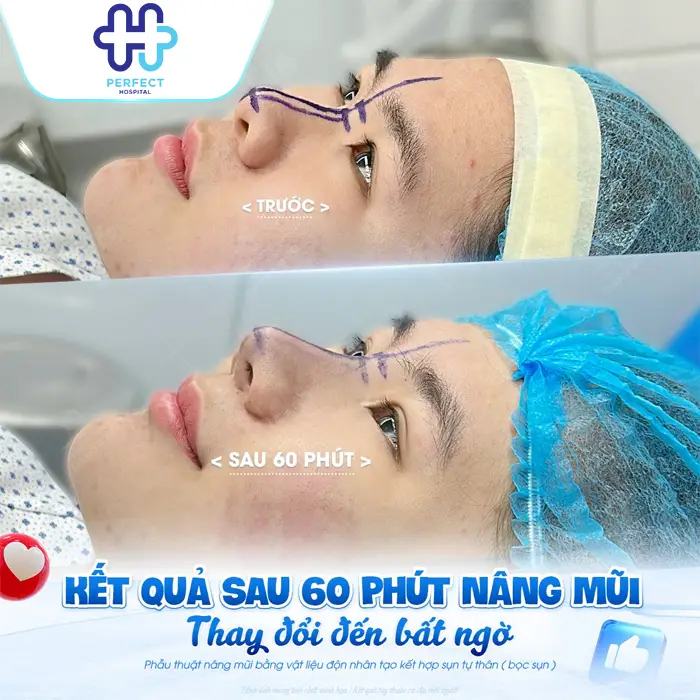 Nâng Mũi Bao Lâu Thì Ổn Định? Thời Gian Để Mũi Đẹp Tự Nhiên