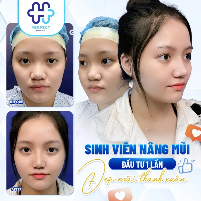 Nâng Mũi Chỉ Collagen Là Gì? Phương Pháp Này Có An Toàn Không?