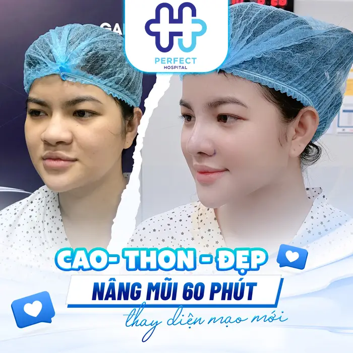 Nâng Mũi Chỉ Collagen Là Gì? Phương Pháp Này Có An Toàn Không?