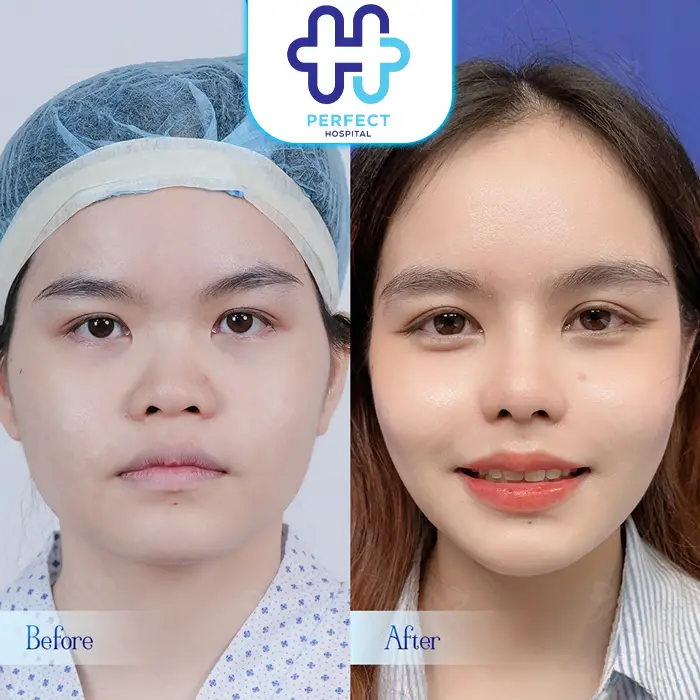 Nâng Mũi Chỉ Collagen Là Gì? Phương Pháp Này Có An Toàn Không?