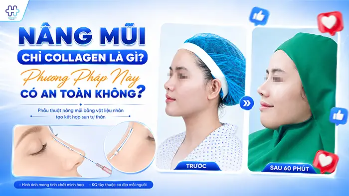 Nâng Mũi Chỉ Collagen Là Gì? Phương Pháp Này Có An Toàn Không?
