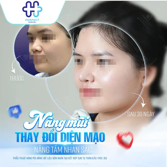 Nâng Mũi Có Để Được Cả Đời Không? Phân Tích Độ Bền Theo Từng Phương Pháp