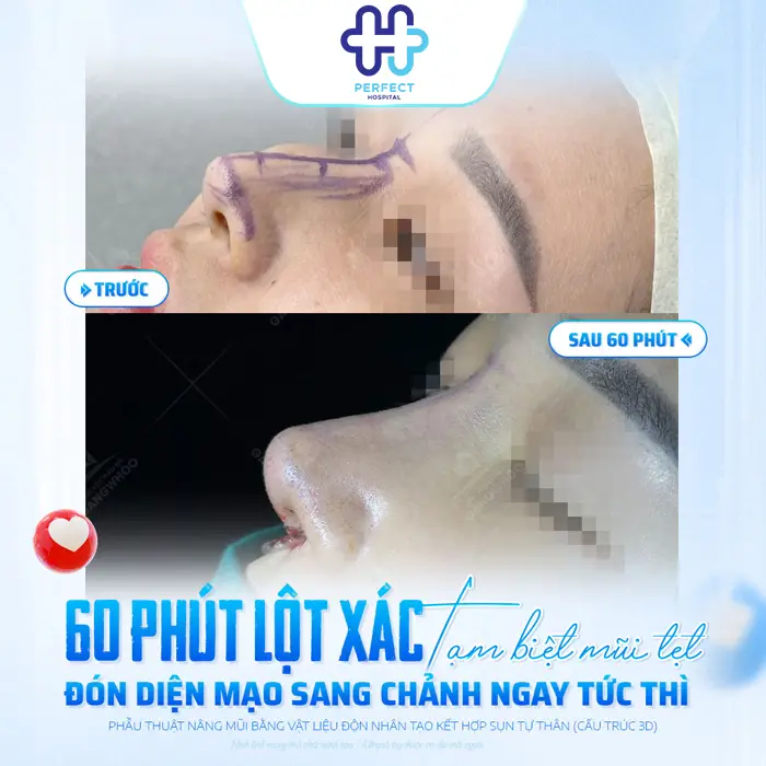 Nâng Mũi Được Bao Lâu? Có Giữ Được Lâu Không? Giải Đáp Chi Tiết