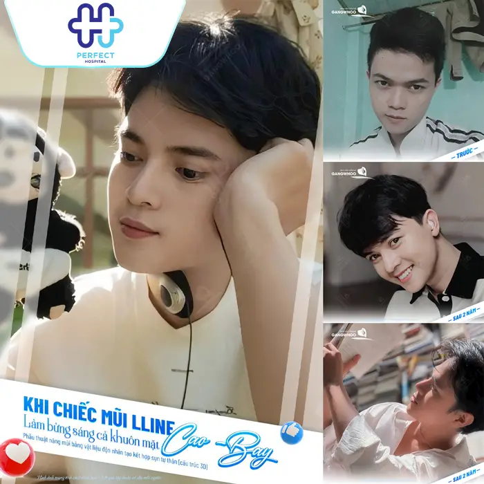 Nâng Mũi Được Bao Lâu? Có Giữ Được Lâu Không? Giải Đáp Chi Tiết