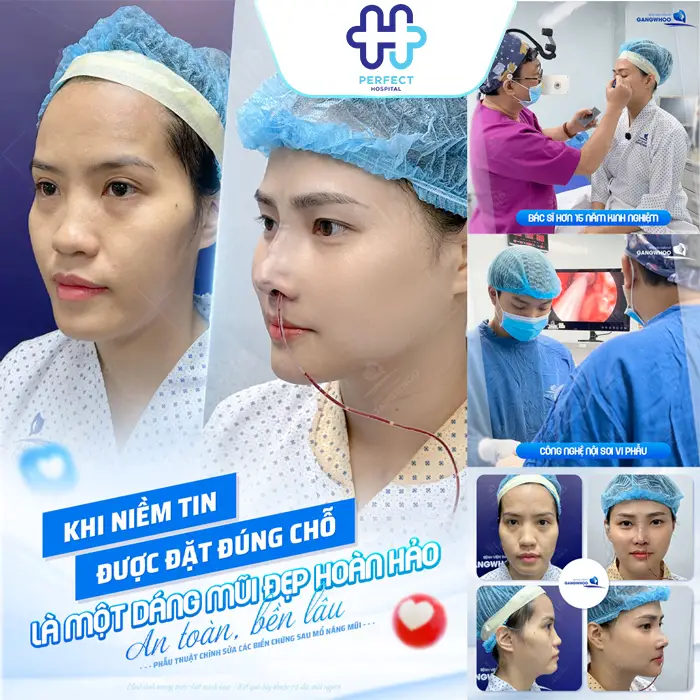 Nâng Mũi Được Bao Lâu? Có Giữ Được Lâu Không? Giải Đáp Chi Tiết