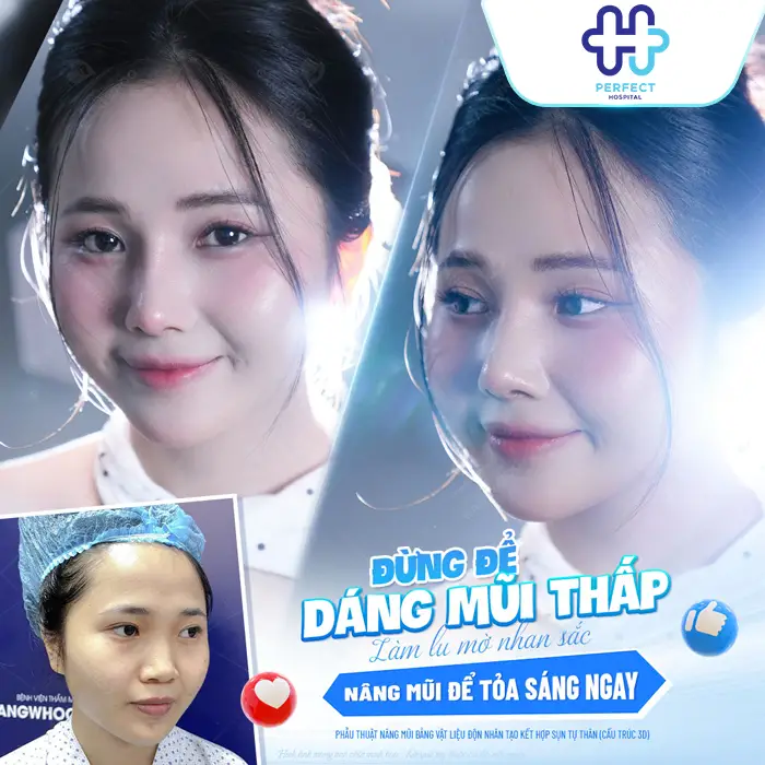 Nâng Mũi Được Bao Lâu? Có Giữ Được Lâu Không? Giải Đáp Chi Tiết