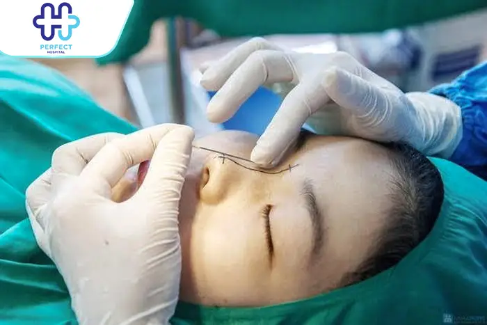 Nâng Mũi Không Phẫu Thuật Là Gì? Có Nên Thực Hiện Hay Không