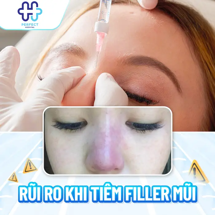 Nâng Mũi Không Phẫu Thuật Là Gì? Có Nên Thực Hiện Hay Không