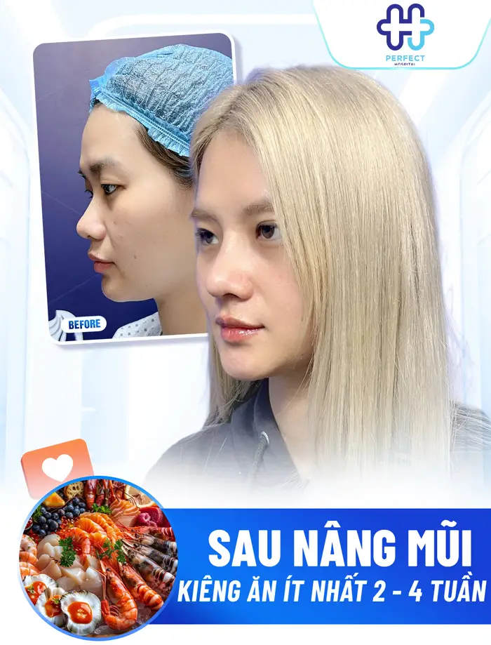 Nâng Mũi Kiêng Ăn Bao Lâu? Thời Gian Ăn Uống Bình Thường Sau Phẫu Thuật