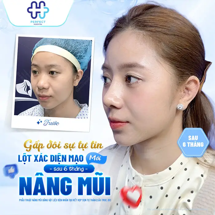 Nâng Mũi Kiêng Ăn Bao Lâu? Thời Gian Ăn Uống Bình Thường Sau Phẫu Thuật