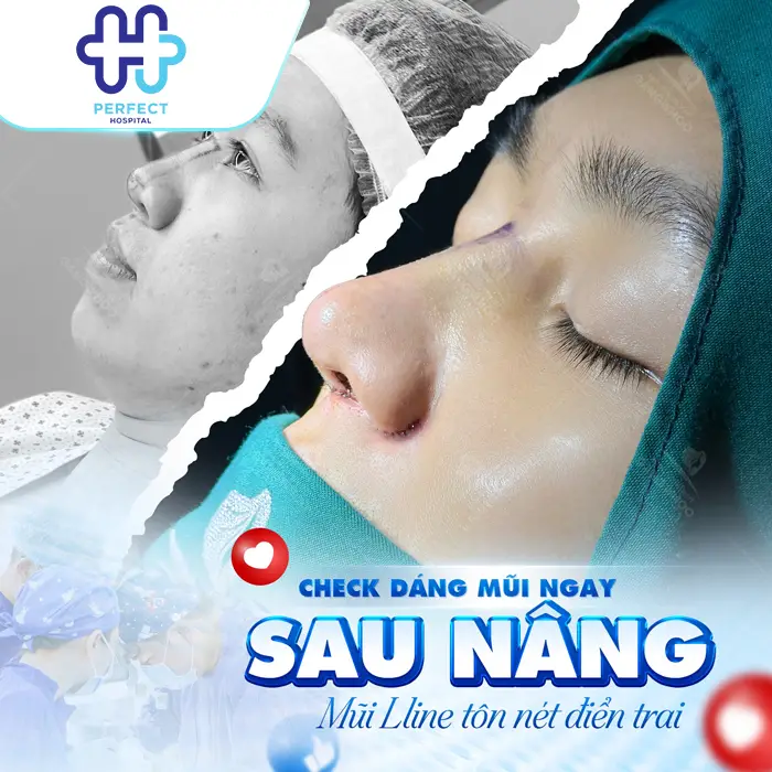 Nâng Mũi L Line Là Gì? Dáng Mũi Cao Tây Được Ưa Chuộng Hiện Nay