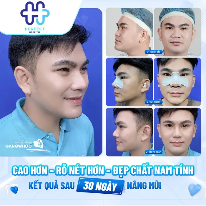 Nâng Mũi L Line Là Gì? Dáng Mũi Cao Tây Được Ưa Chuộng Hiện Nay