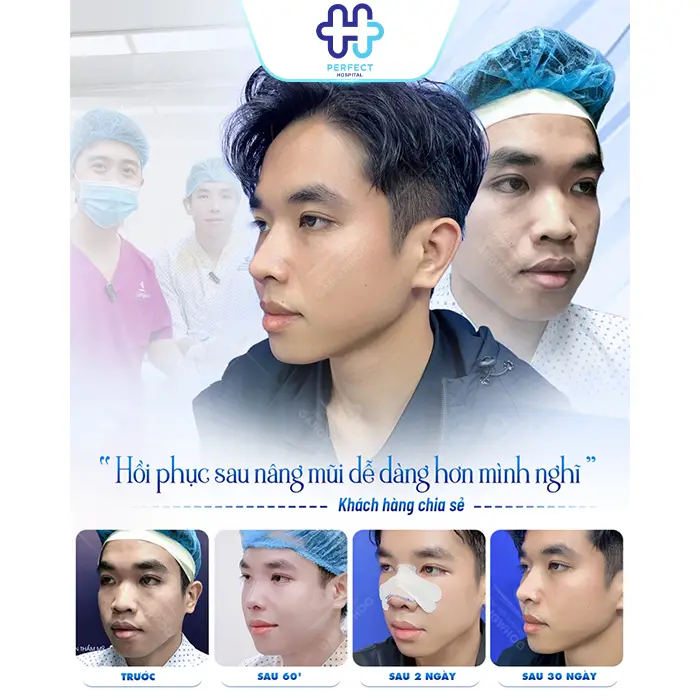 Nâng Mũi L Line Là Gì? Dáng Mũi Cao Tây Được Ưa Chuộng Hiện Nay