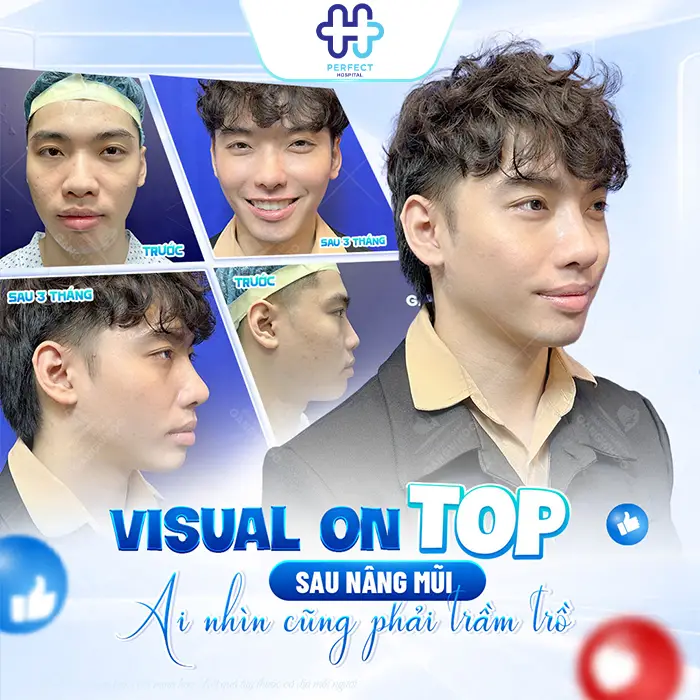 Nâng Mũi L Line Là Gì? Dáng Mũi Cao Tây Được Ưa Chuộng Hiện Nay