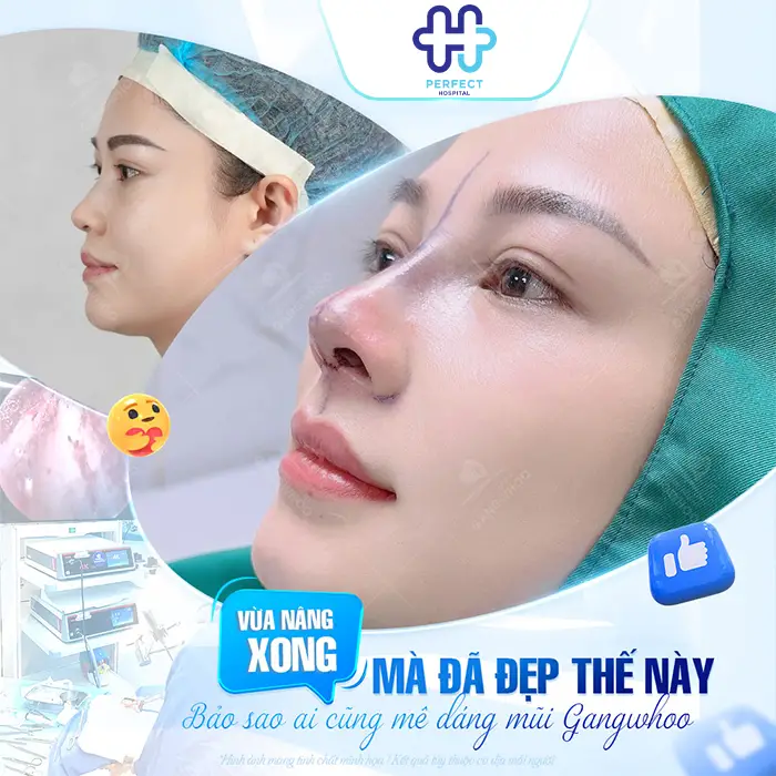 Nâng Mũi L Line Là Gì? Dáng Mũi Cao Tây Được Ưa Chuộng Hiện Nay