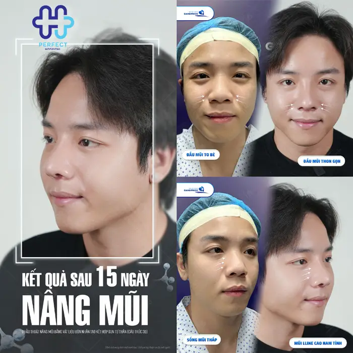 Nâng Mũi Nam Giới Có Nên Không? Giải Pháp Tạo Dáng Mũi Nam Tính, Tự Nhiên