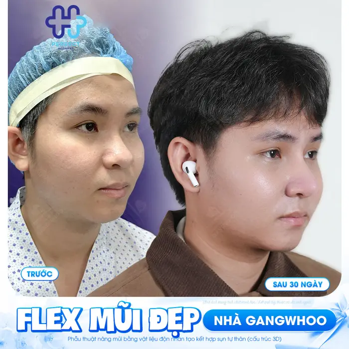 Nâng Mũi Nam Giới Có Nên Không? Giải Pháp Tạo Dáng Mũi Nam Tính, Tự Nhiên