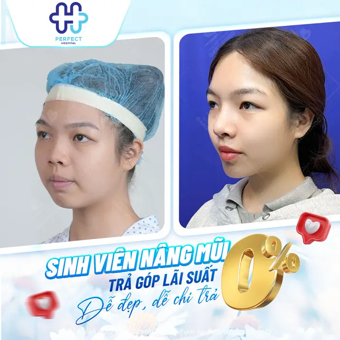 Nâng Mũi Trả Góp Giá Bao Nhiêu? Chính Sách Trả Góp Tại Perfect Hospital