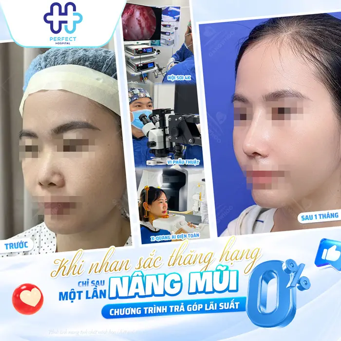 Nâng Mũi Trả Góp Giá Bao Nhiêu? Chính Sách Trả Góp Tại Perfect Hospital