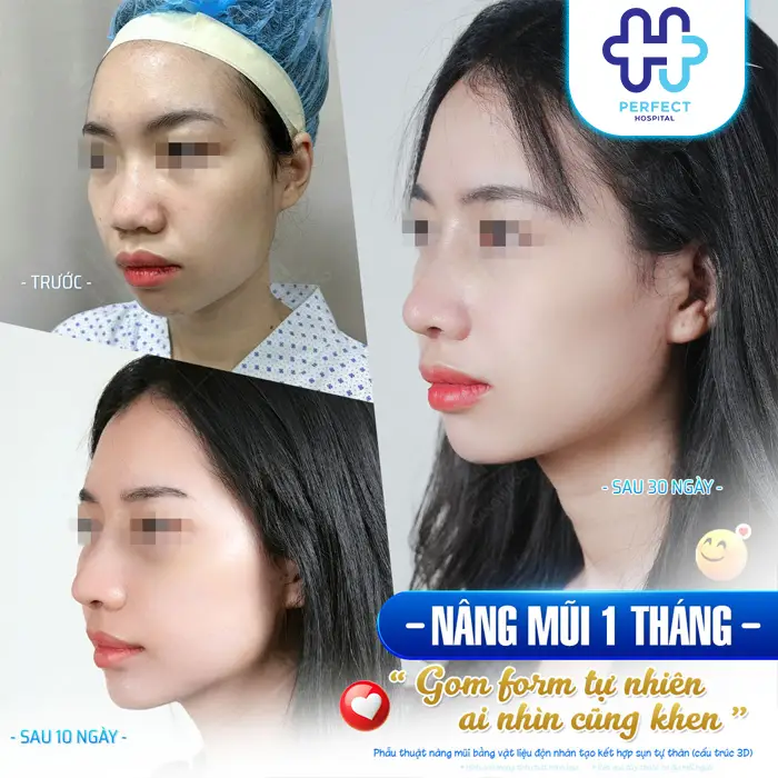 Cách Nâng Mũi Tự Nhiên An Toàn Giúp Sở Hữu Dáng Mũi Đẹp Tự Nhiên