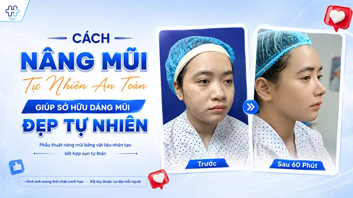 Cách Nâng Mũi Tự Nhiên An Toàn Giúp Sở Hữu Dáng Mũi Đẹp Tự Nhiên