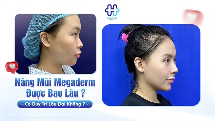 Nâng Mũi Megaderm Được Bao Lâu? Có Duy Trì Lâu Dài Không?