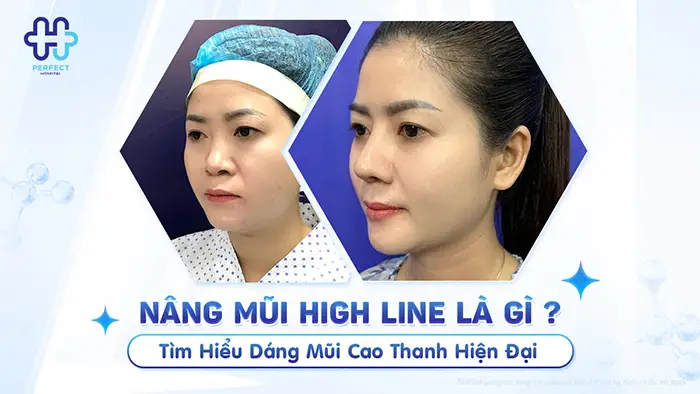 Nâng Mũi High Line Là Gì? Tìm Hiểu Dáng Mũi Cao Thanh Hiện Đại