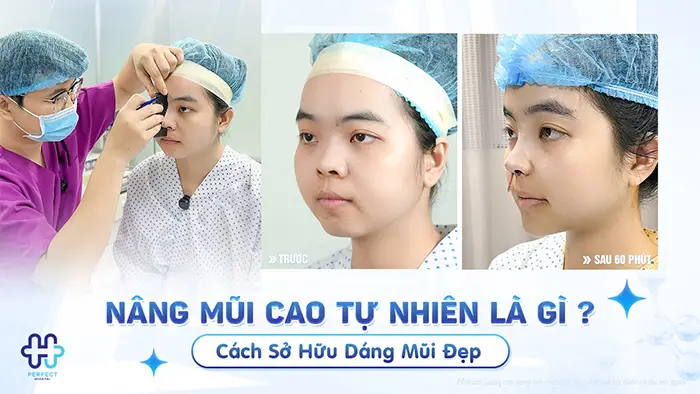 Nâng Mũi Cao Tự Nhiên Là Gì? Cách Sở Hữu Dáng Mũi Đẹp