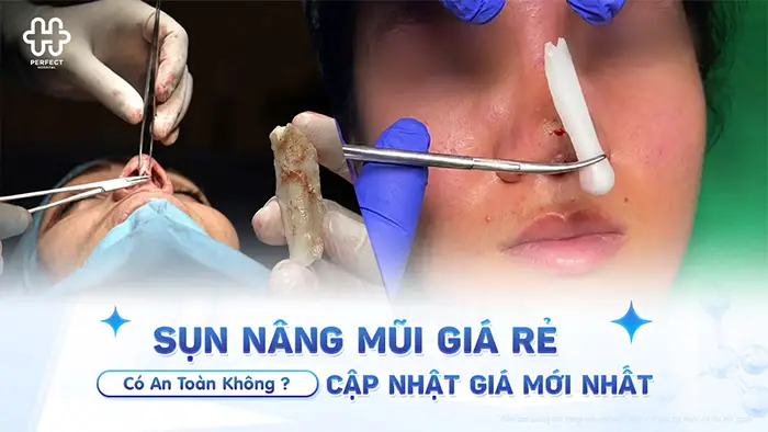 Sụn Nâng Mũi Giá Rẻ Có An Toàn Không? Cập Nhật Giá Mới Nhất
