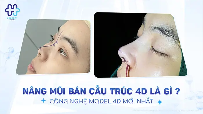 Nâng Mũi Bán Cấu Trúc 4D Là Gì? Công Nghệ Model 4D Mới Nhất