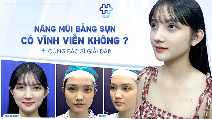 Nâng Mũi Bằng Sụn Có Vĩnh Viễn Không? Cùng Bác Sĩ Giải Đáp