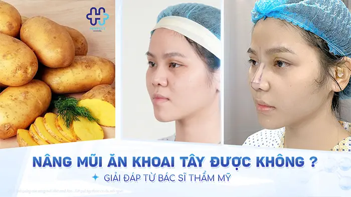 Nâng Mũi Ăn Khoai Tây Được Không? Giải Đáp Từ Bác Sĩ Thẩm Mỹ
