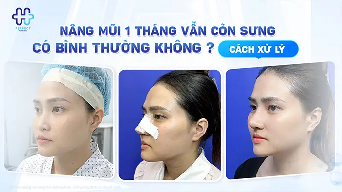 Nâng Mũi 1 Tháng Vẫn Còn Sưng Có Bình Thường Không? Cách Xử Lý