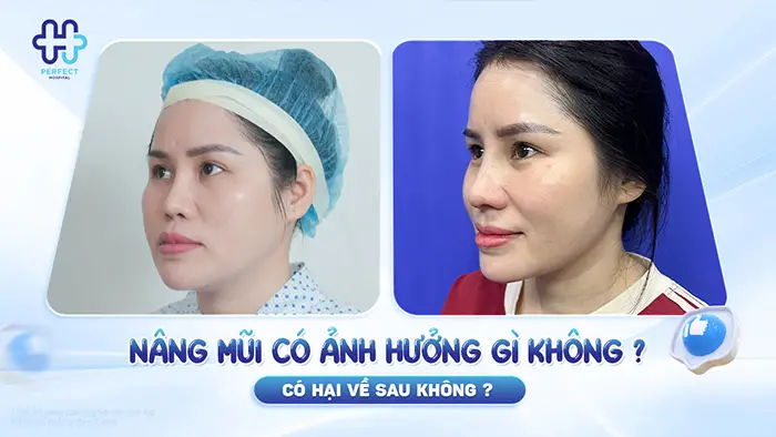 Nâng mũi có ảnh hưởng gì không? Có hại về sau không?