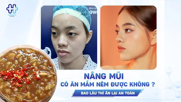 Nâng Mũi Có Ăn Mắm Nêm Được Không? Bao Lâu Thì Ăn Lại An Toàn