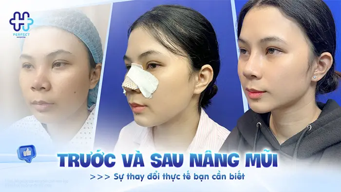 Trước và sau nâng mũi: Sự thay đổi thực tế bạn cần biết
