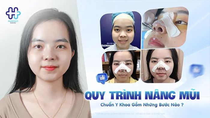 Quy Trình Nâng Mũi Chuẩn Y Khoa Gồm Những Bước Nào?