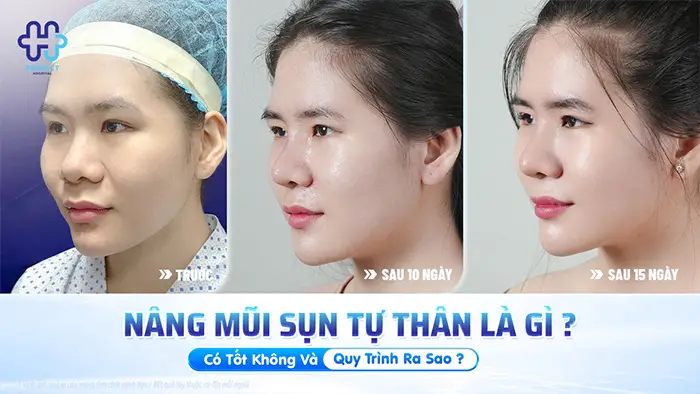Nâng Mũi Sụn Tự Thân Là Gì? Có Tốt Không Và Quy Trình Ra Sao?