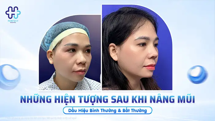 Những Hiện Tượng Sau Khi Nâng Mũi: Dấu Hiệu Bình Thường & Bất Thường