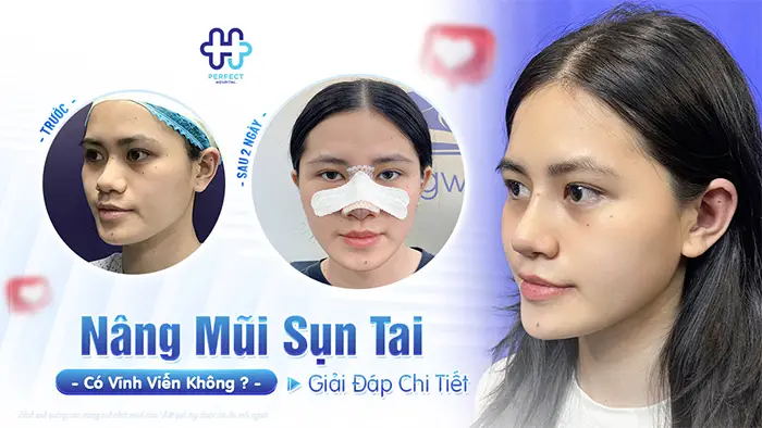 Nâng Mũi Sụn Tai Có Vĩnh Viễn Không? Giải Đáp Chi Tiết