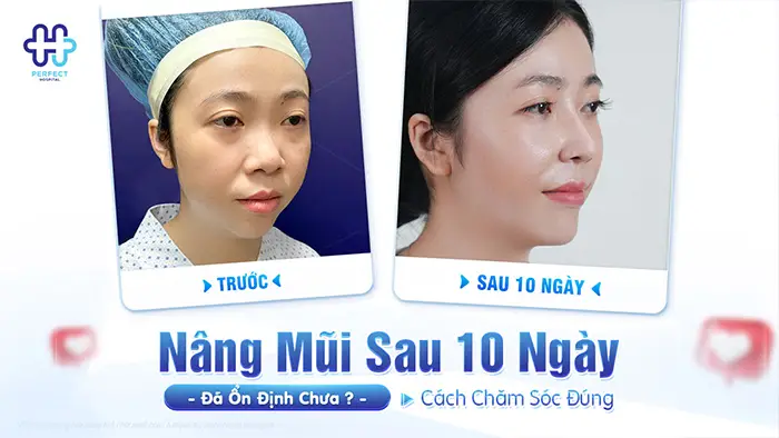 Nâng Mũi Sau 10 Ngày Đã Ổn Định Chưa? Cách Chăm Sóc Đúng