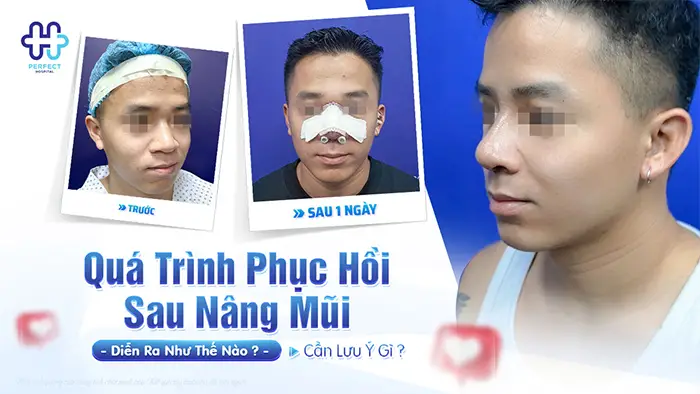 Quá Trình Phục Hồi Sau Nâng Mũi Diễn Ra Như Thế Nào? Cần Lưu Ý Gì?