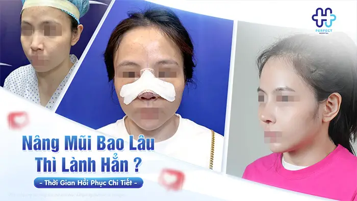 Nâng Mũi Bao Lâu Thì Lành Hẳn? Thời Gian Hồi Phục Chi Tiết