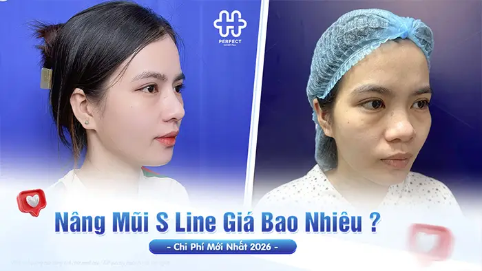 Nâng Mũi S Line Giá Bao Nhiêu? Chi Phí Mới Nhất 2026