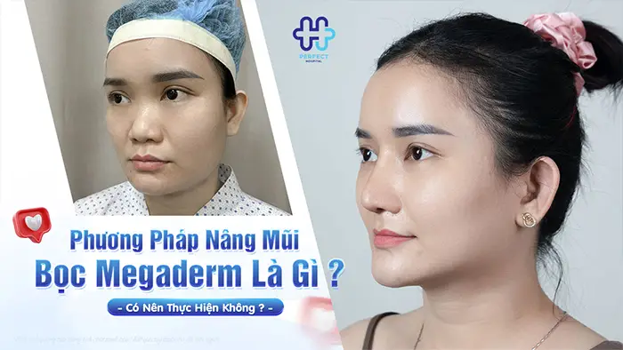 Phương Pháp Nâng Mũi Bọc Megaderm Là Gì? Có Nên Thực Hiện Không?