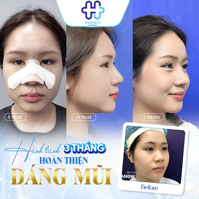 Bao Nhiêu Tuổi Mới Được Nâng Mũi? Độ Tuổi Phẫu Thuật An Toàn
