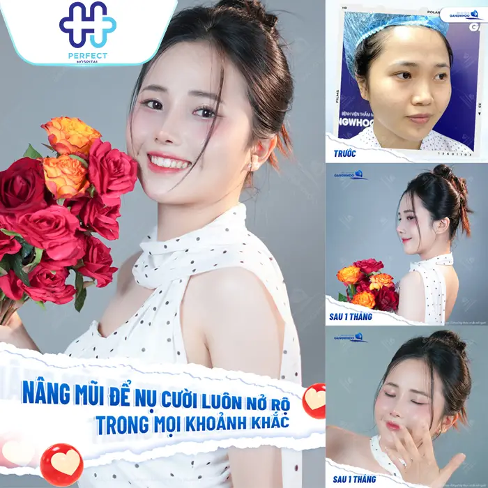 Bao Nhiêu Tuổi Mới Được Nâng Mũi? Độ Tuổi Phẫu Thuật An Toàn