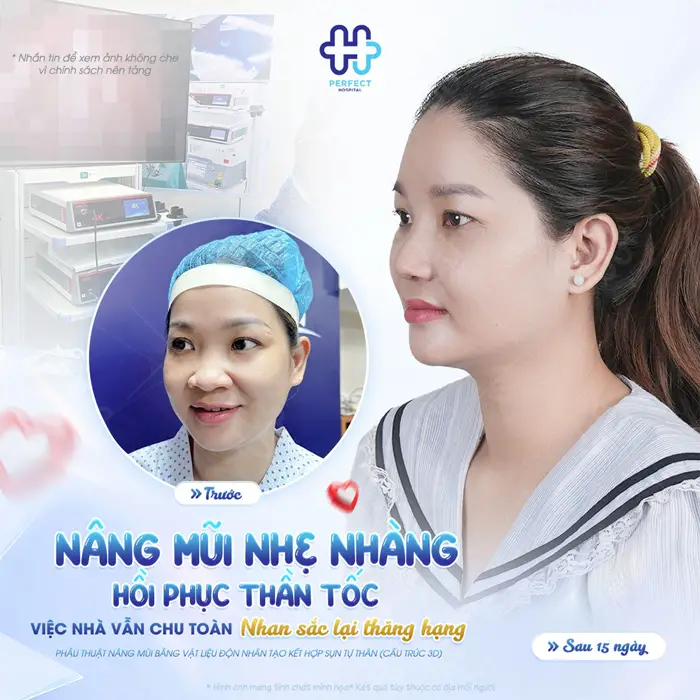 Bị Viêm Mũi Dị Ứng Có Nâng Mũi Được Không? Giải Đáp Chi Tiết