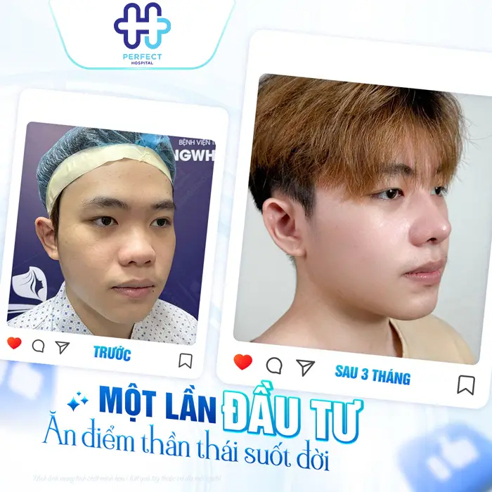 Bị Viêm Mũi Dị Ứng Có Nâng Mũi Được Không? Giải Đáp Chi Tiết